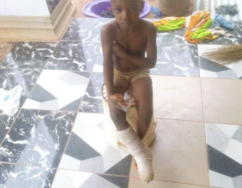 Mother seeks financial assistance to treat five-year-old daughter’s fractured leg