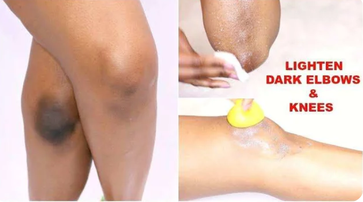 Natural Ways To Remove Darkness From Elbows And Knees