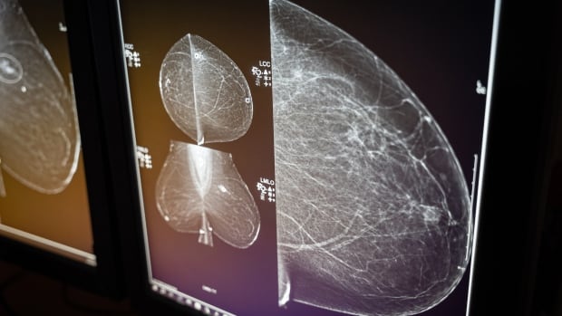 B.C. patients worry as breast cancer screening wait times climb
