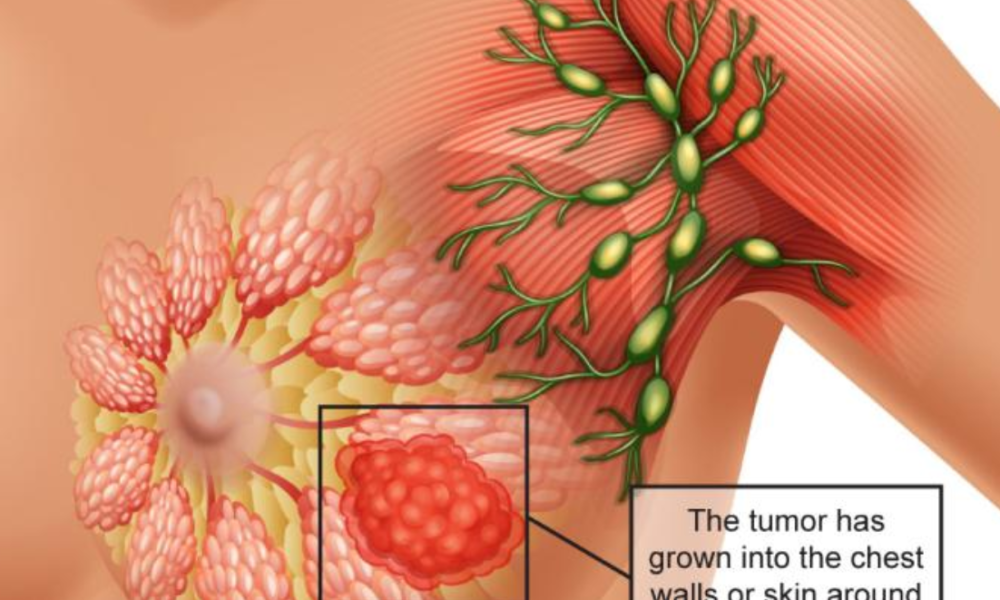 5 Essential Signs Of Breast Cancer That Are Noticeable On Some Parts Of The Body