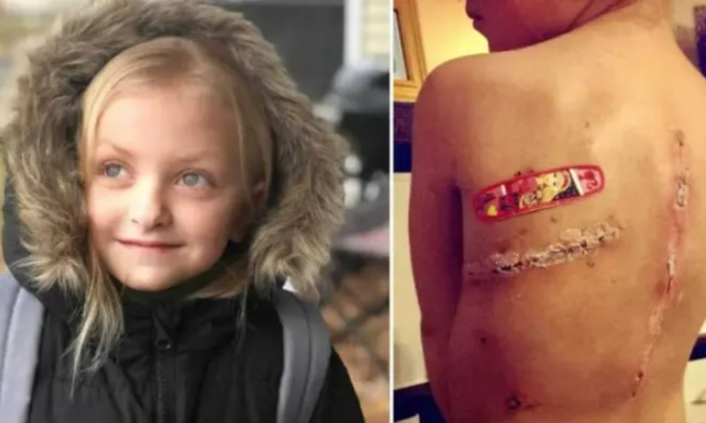 BRAVE GIRL BEATS CANCER BUT KIDS MOCK HER SCARS – FED-UP MOM CONFRONTS HER BULLIES