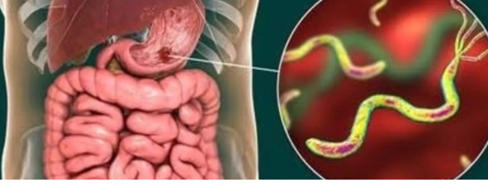 Causes, Symptoms, And Treatment For Stomach Ulcer Disease