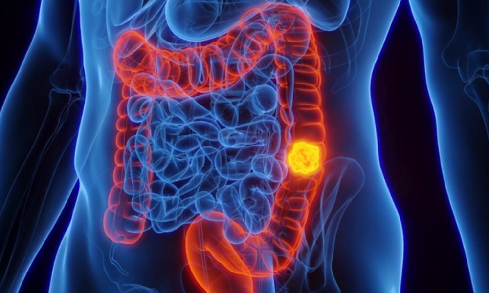Four colon cancer symptoms that are ‘often dismissed’, as revealed by a doctor