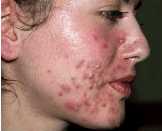 Here Are Seven Things That Can Cause Pimples You Should Stop Doing Them