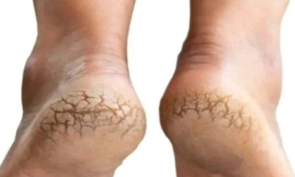 Here is What Causes Cracked Heels And How To help Heal Them