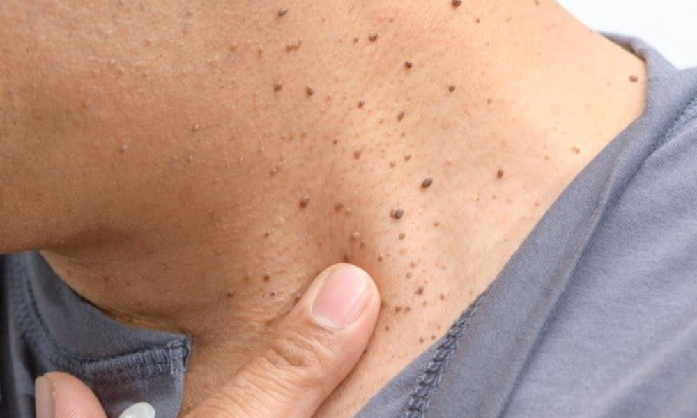 Home Remedies For Removing Skin Tags