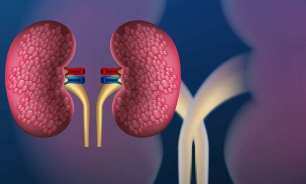 How to detect Kidney Cancer? Signs to watch out for and treatment options