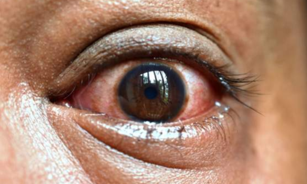 How to stay safe from red eye infection