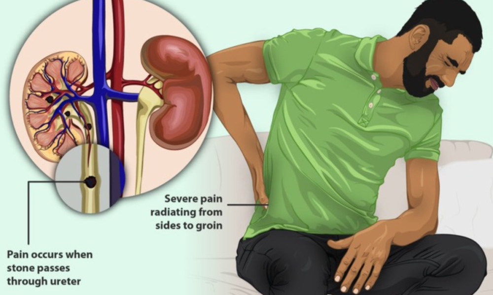 Kidney Stones: Understanding, Prevention, and Treatment
