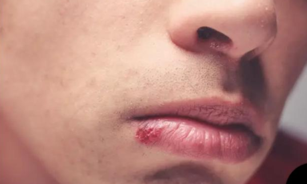 Kissing Could Bring You These 8 Deadly Diseases