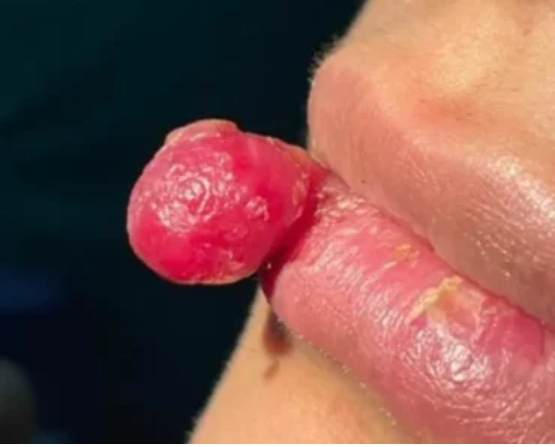 Reality Bites: Two Women Grow TUMORS On Their Lips And Tongues After Suffering Injuries While Chewing On Food
