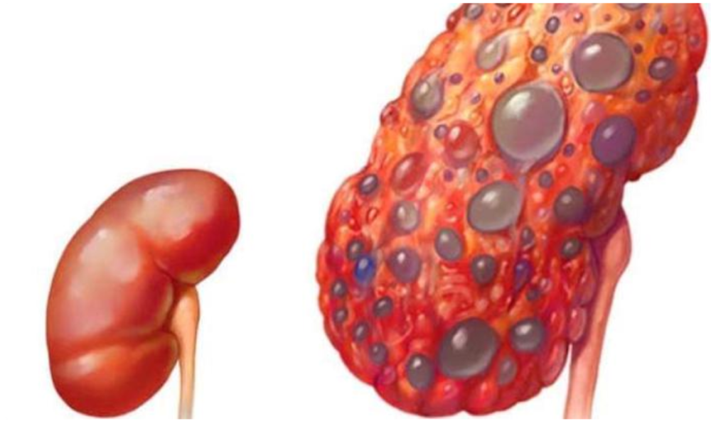 Signs and symptoms of kidney stones in men