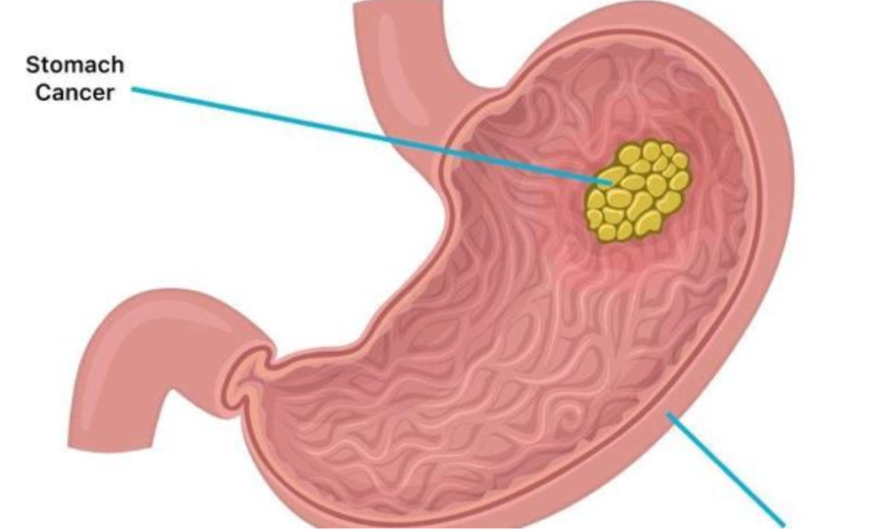 Stomach Cancer Kills Fast: Avoid Too Much Intake Of These 3 Things If You Want To Live Long