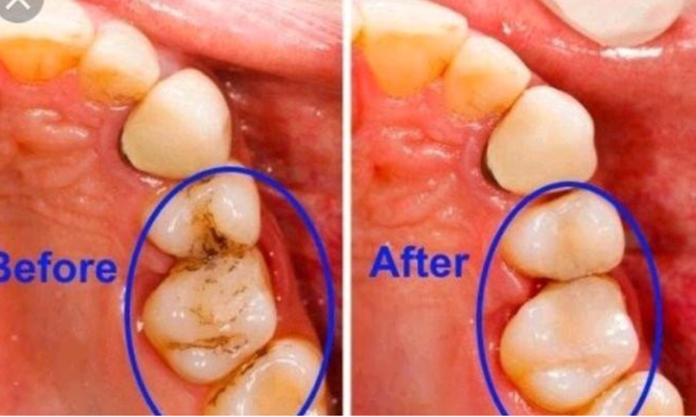 Stop Wasting money on dentists: Use these simple methods to cure tooth decay in your home