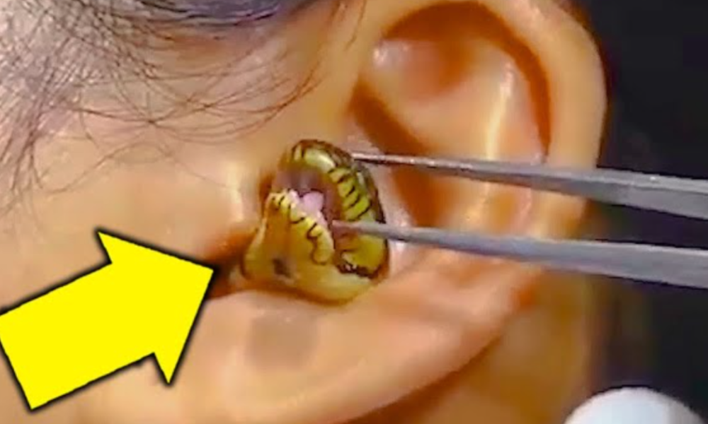 Surgeon Struggles to Remove Live Snake From Woman’s Ear, then This Happened