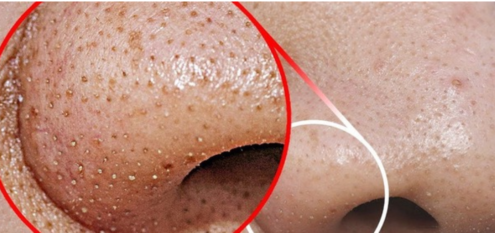 The Best Methods For Removing Blackheads From Nose