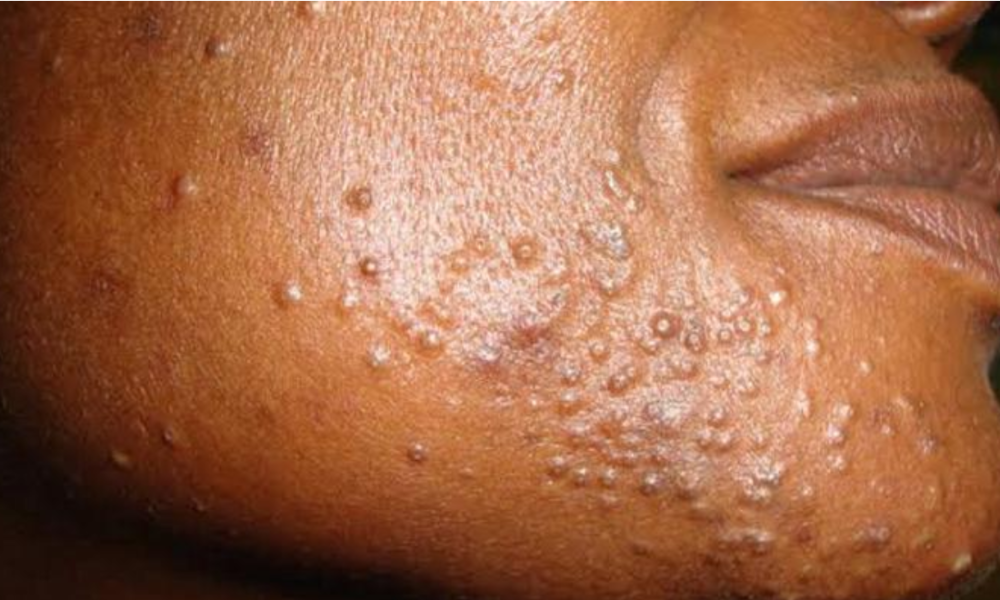 These Are Things That Bring Pimples You Must Stop Doing