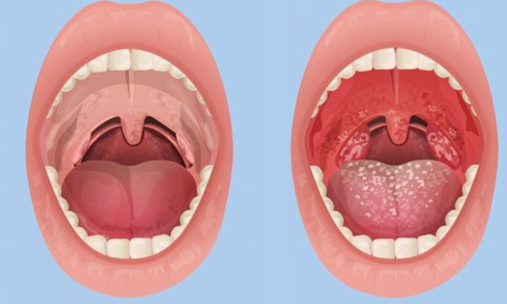 Things You Should Know About Tonsillitis