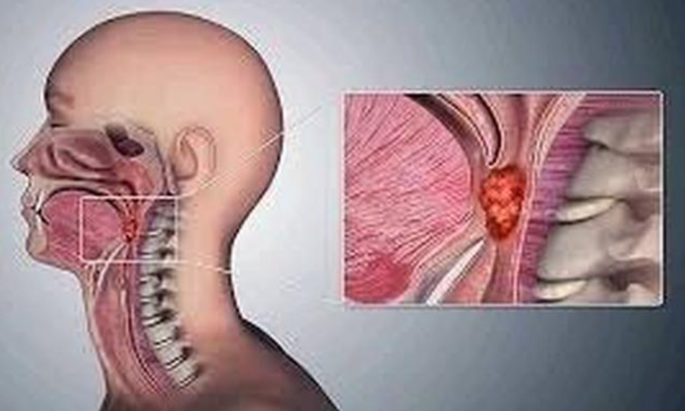 Throat Cancer Kills Fast, Avoid this Three Things To Save Your Life