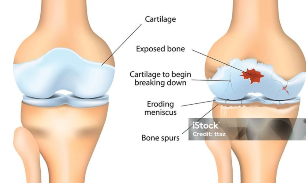 Understanding the Intricacy of Osteoarthritis