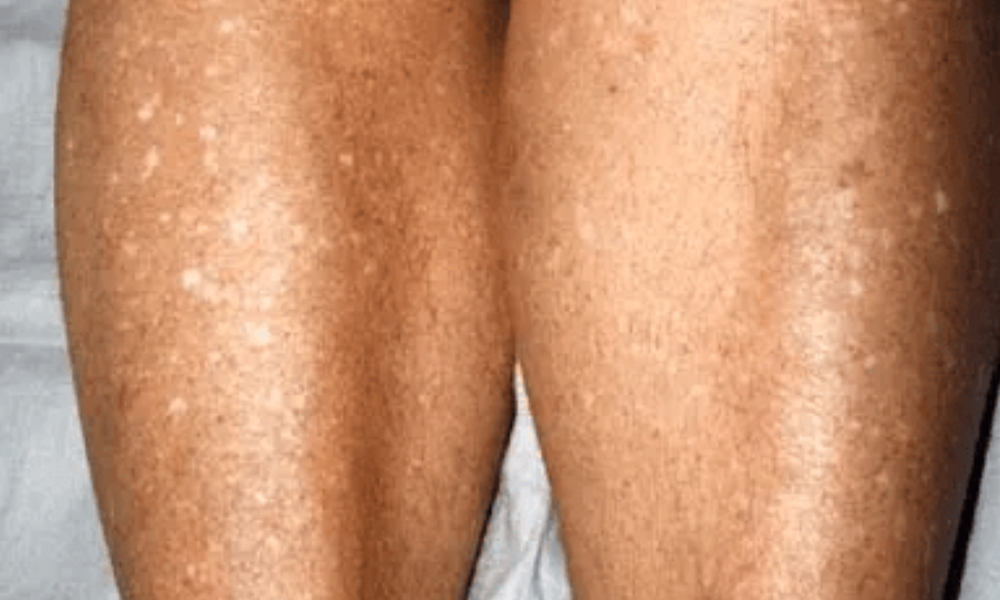 What Causes White Spots On Legs And How To Remove Them