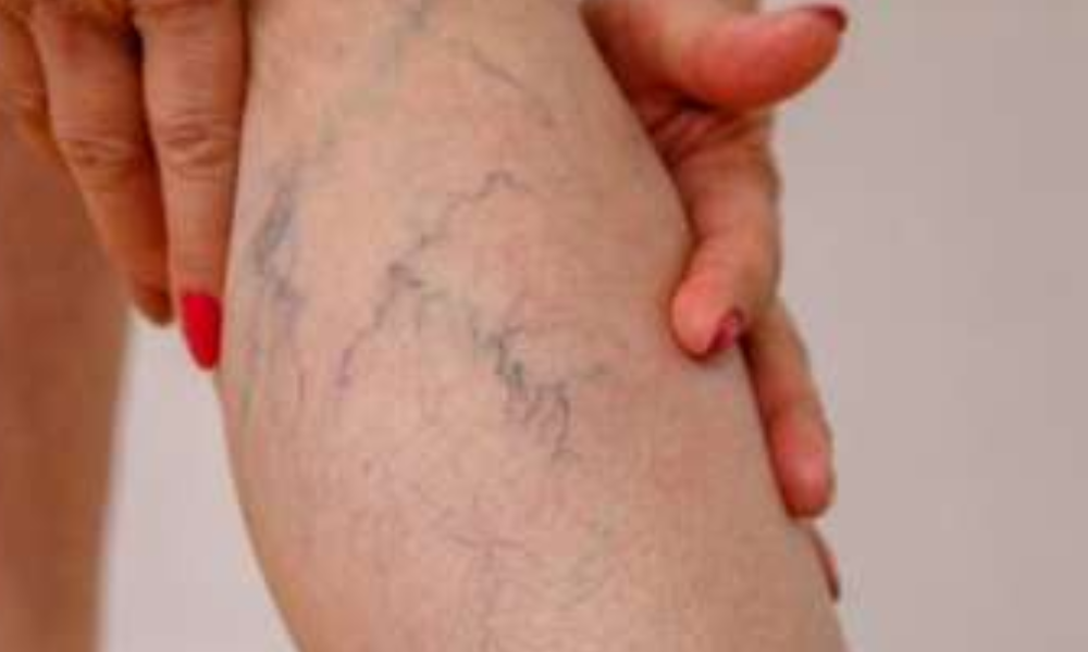 What is Varicose Veins? Know symptoms, causes and treatment of this common condition
