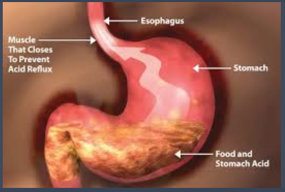 4 Undeniable Facts About Gastric Acid Disease or