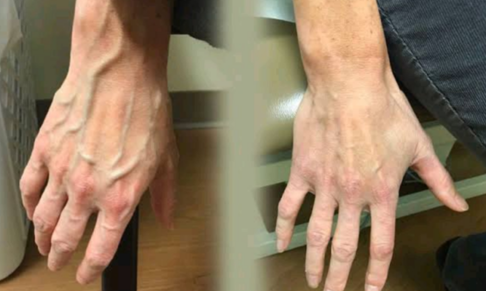 5 Reasons Why Some People Veins Appear Visible On Their Skin