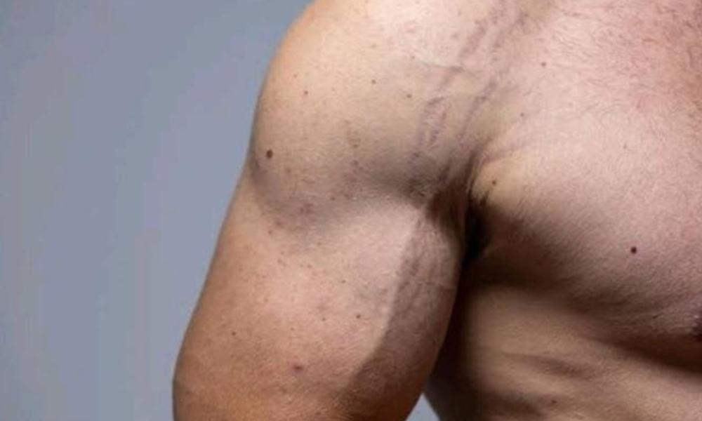 5 Secrets Reasons Why Some Men Have Stretch Marks