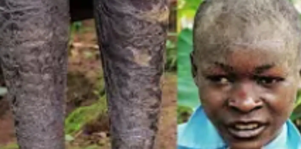 BORN DIFFERENT: 15-Year-Old Boy Who Is Slowly Turning Into a Tree Sh0cked Everyone (Video)
