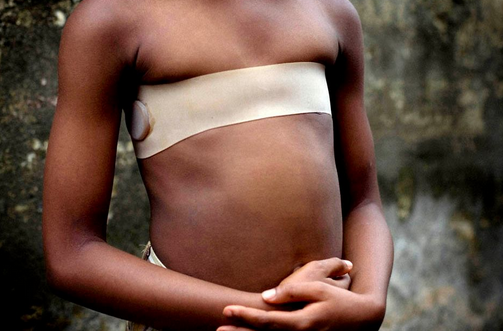 Breast ironing: culture that defies modernism