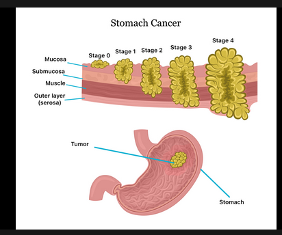 Cancer Of The Stomach Kills, Stop Eating These Three Things If You Want To Live Long