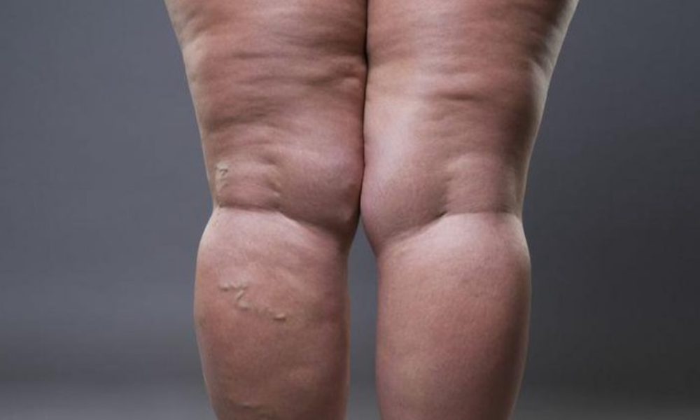 Cellulite: Here's what they are and how to get rid of them