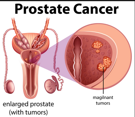Does Releasing Sperm On A Regular Basis Help Prevent Prostate Cancer