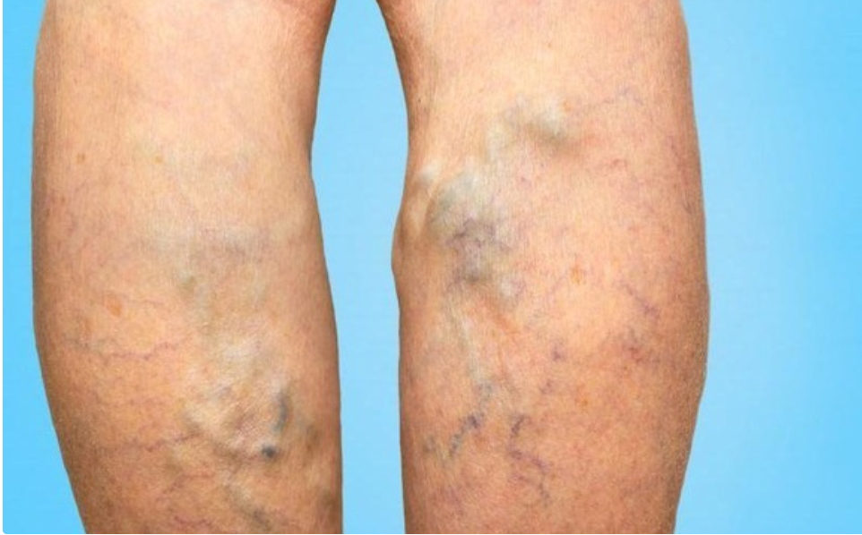 Five Reasons Why Some People’s Veins Are Visible On Their Skin