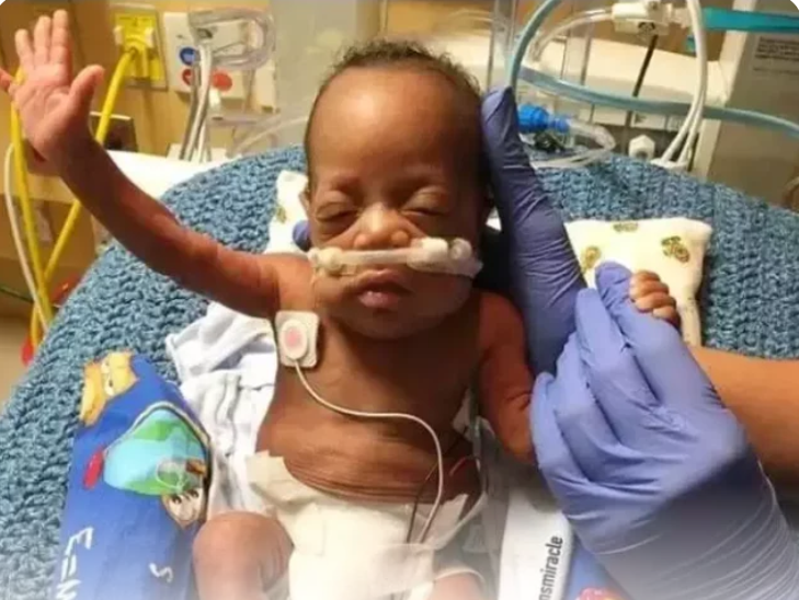 He Was Born In 5 Months Instead Of 9 Months, Doctors Said He Might Not Make It, See How He Looks Now