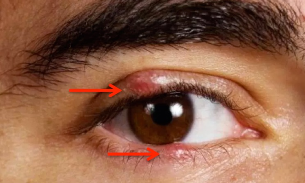 How To Use Colloidal Silver To Heal Eye Infections Overnight!