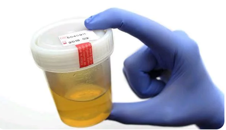 Signs Of Kidney Problems That May Be Noticeable In The Urine