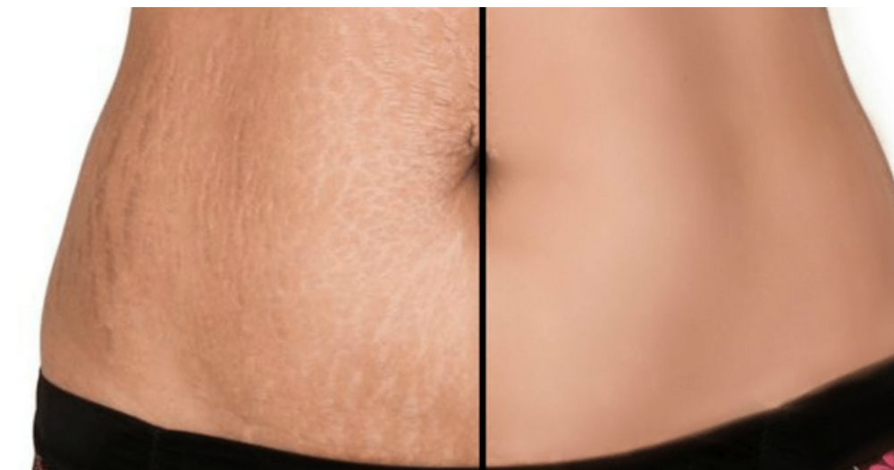 Simple Methods To Get Rid Of Stretch Marks From Your Body