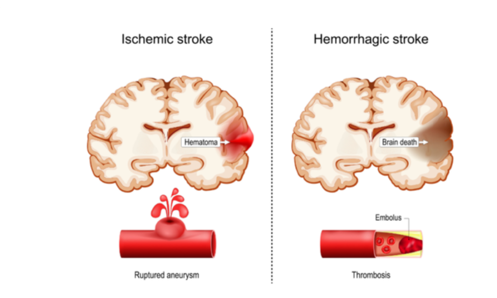 Spot These 10 Warning Signs Of A Stroke One Week Before