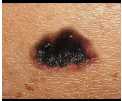 Terrifying time-lapse video reveals how a tiny dark blotch can morph into stage 4 skin cancer