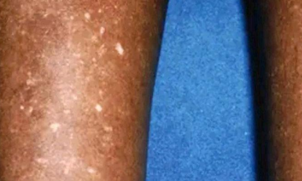 White Spots On Legs: What Causes Them And How To Get Rid Of Them