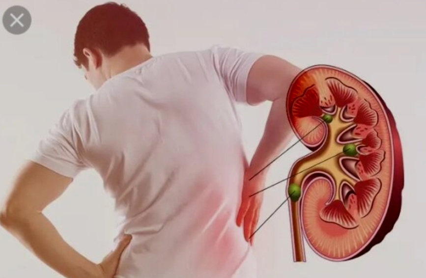 Your kidney is failing if you experience this early signs