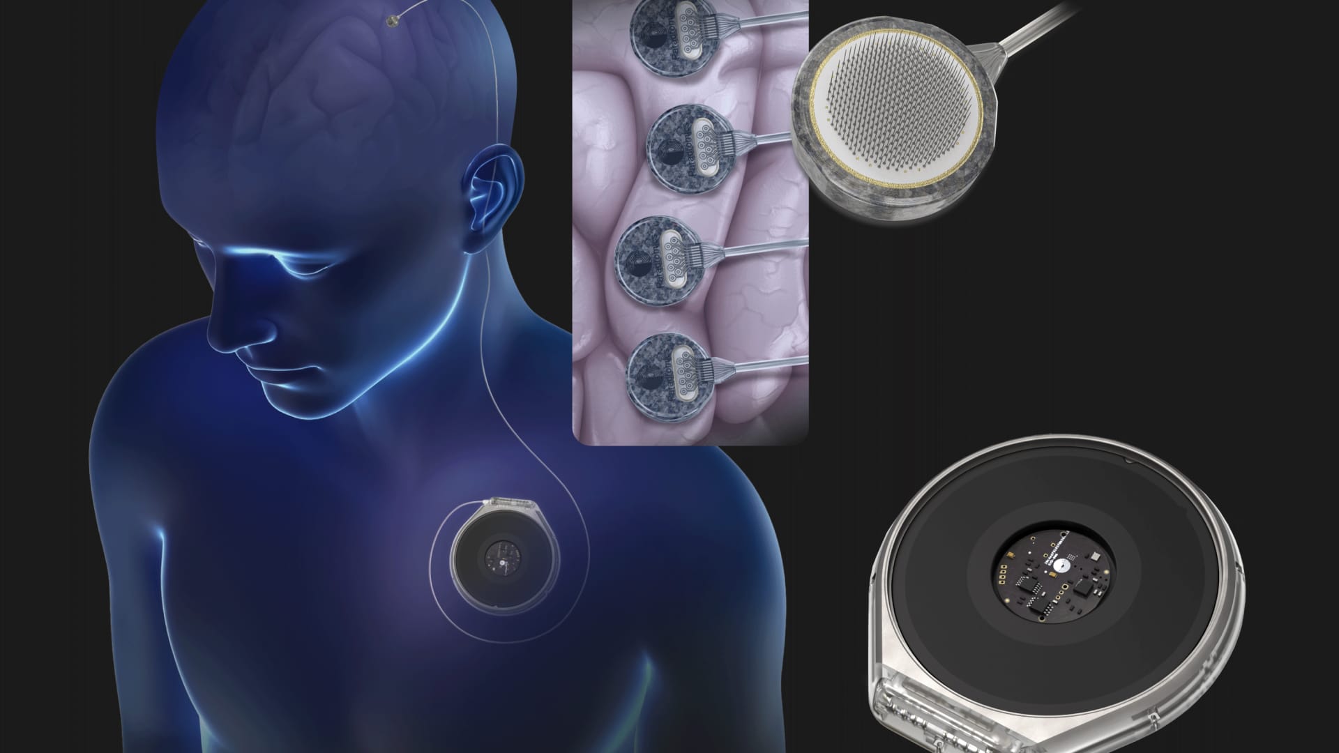 Paradromics gears up to test its brain implant on humans