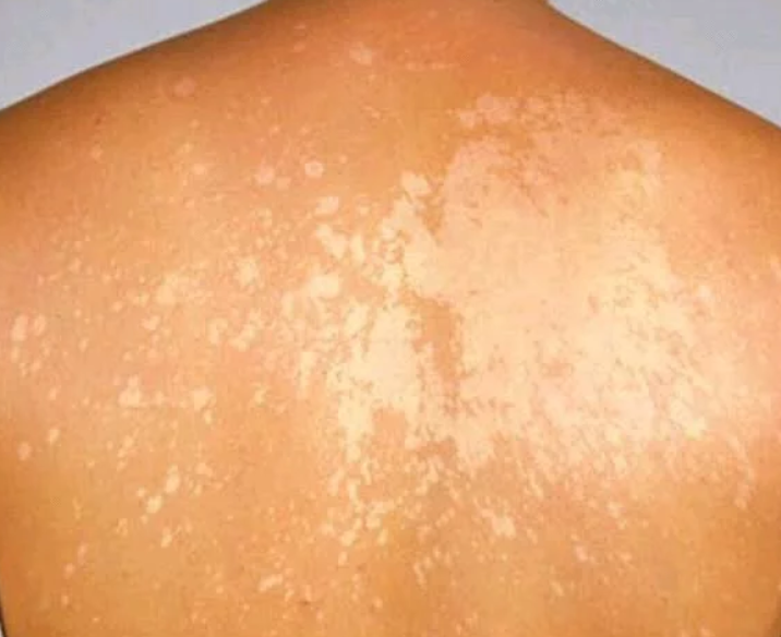 Here Are 3 Causes Of White Spots On Your Skin