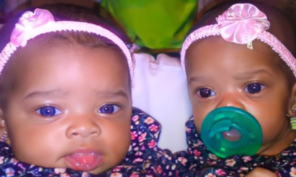 Remember These Twins That Were Born With Blue Eyes? This Is How They Look Now!
