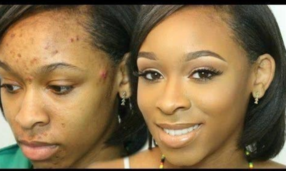 Say Goodbye to Pimples Forever by Following these 6 Simple Steps – opinion