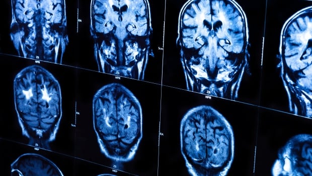 Scientist working on mystery N.B. brain condition claimed he was 'cut off' for 'political' reasons