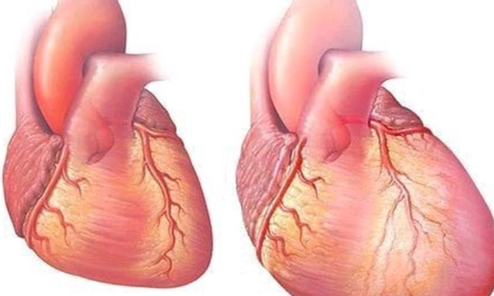 Protect Your Heart From Heart Failure By Avoiding Too Much Intake Of These Three Things.