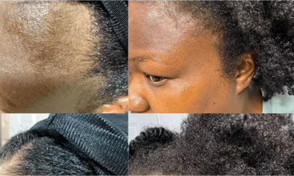 5 ways to naturally regrow your hairline